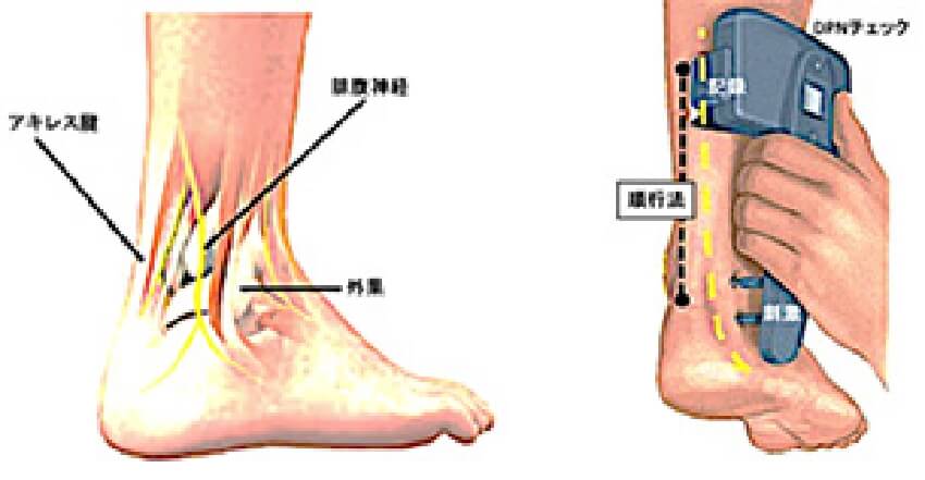 簡易型感覚神経伝導検査DPNチェック1