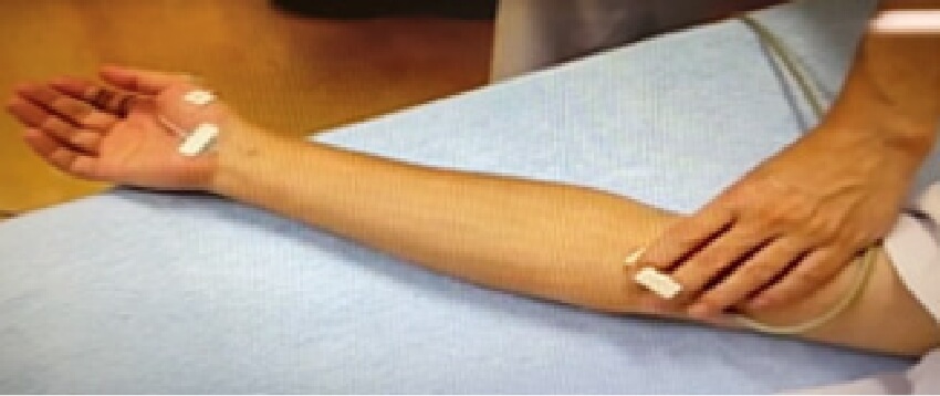 末梢神経伝導検査2