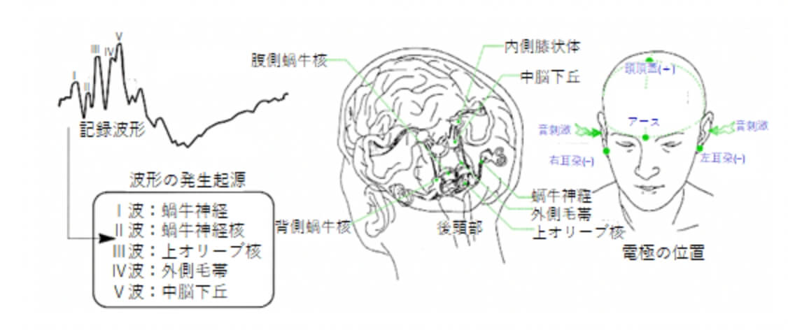 誘発電位検査(ABR)